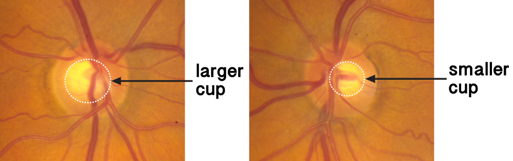 fundus photos of optic nerve cupping